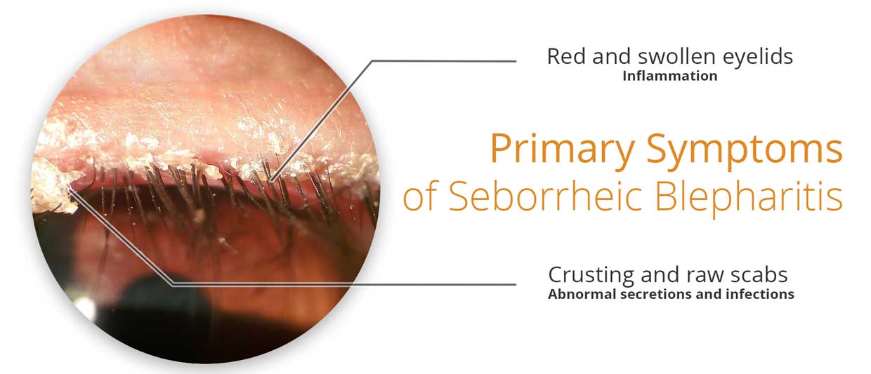 Image showing the primary symptooms of seborrheic dermatitis of the eyelids (properly known as seborrheic blepharitis).