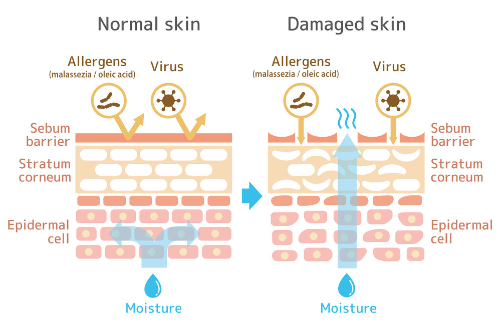 Difference between health skin and skin affected by seborrheic dermatitis or dandruff